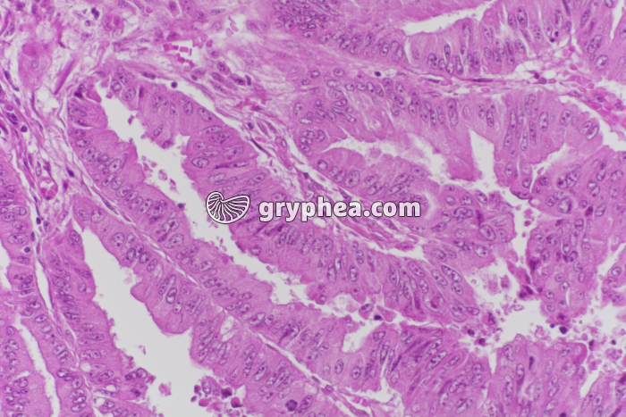 Cancer de la vésicule biliaire x100 - gryphea.org